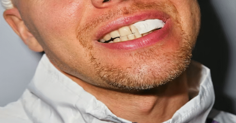 Johnny Depp Teeth